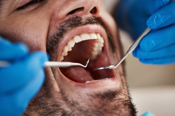 Best Emergency Tooth Extraction in Fishers, IN